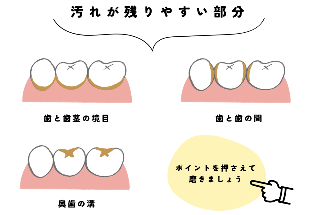 歯の汚れが残りやすい部分